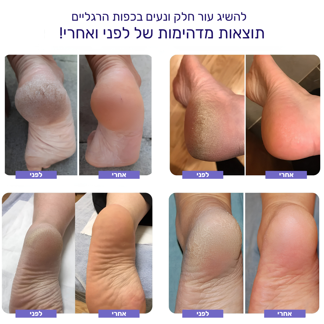 FootBar™ - מסיר עור יבש ויבלות מכפות הרגליים
